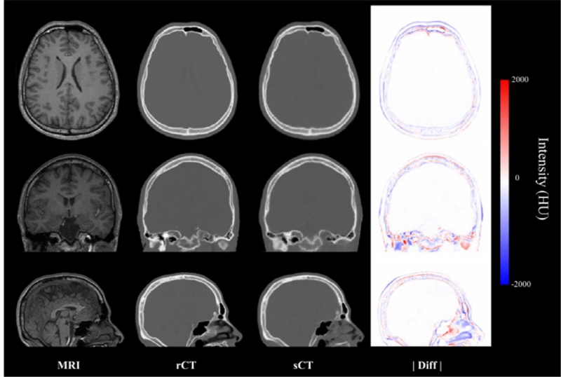 MRI rCT sCT |diff| Intensity(HU)