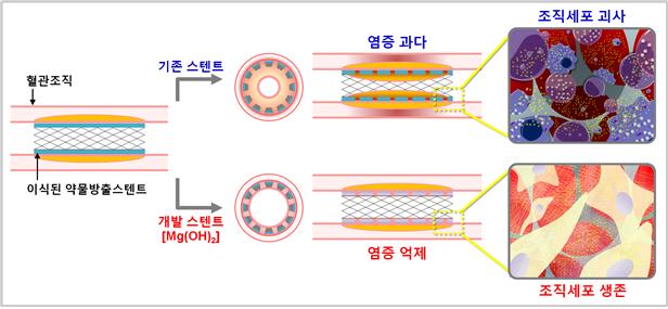 개발된 약물방출 스텐트의 염증억제 작용기전을 나타낸 그림.