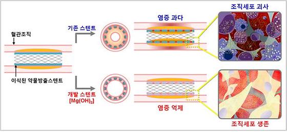 심장질환, 차세대 염증억제 약물방출 스텐트로 해결한다